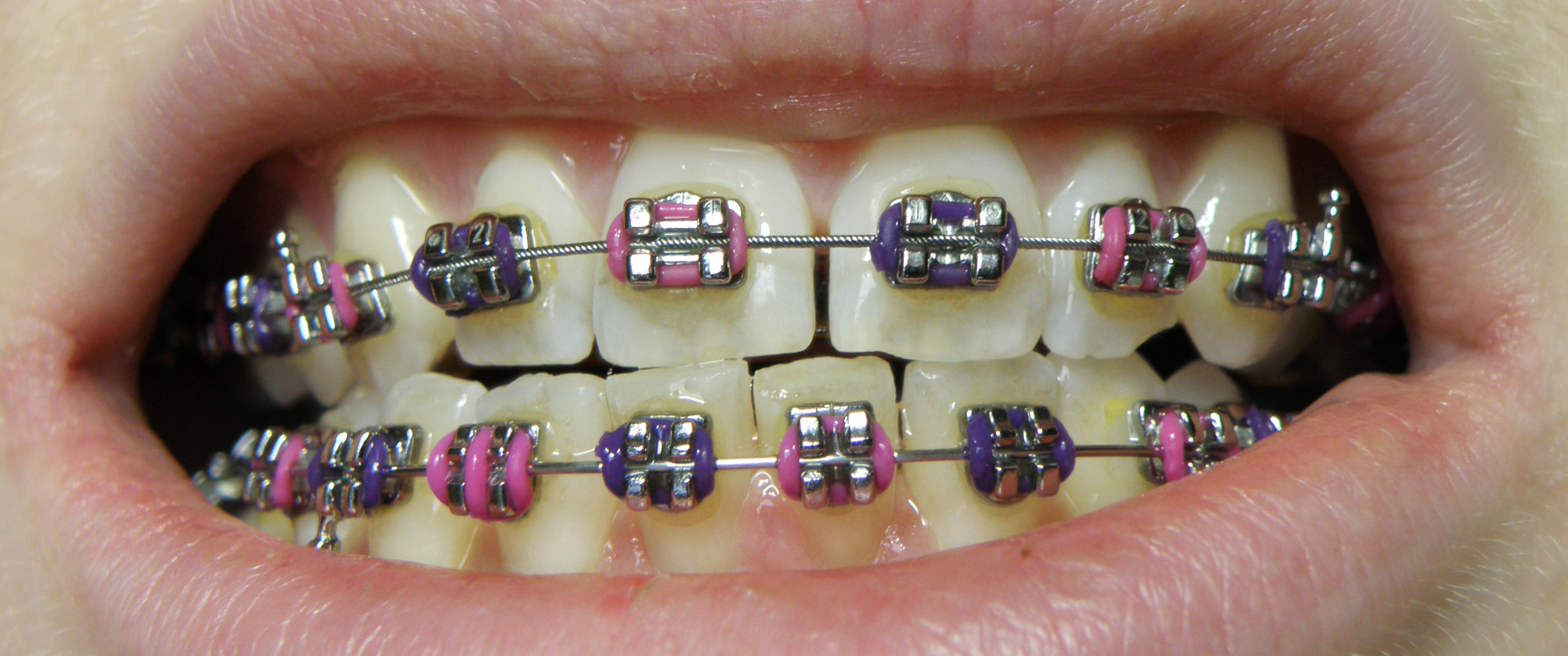 spazzolino apparecchio denti